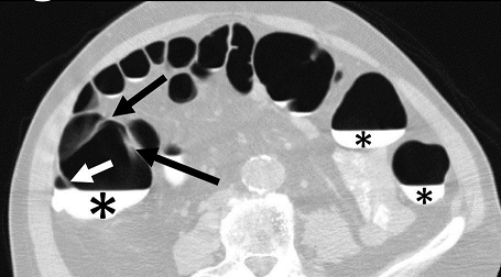 Axial CT-Colonography image demonstrating dependent fluid tagging (*) obscuring a dependent haustral fold (white arrow) with a pair of unobscured, non-dependent haustral folds (black arrows). Note: difficulty in visualization of haustral fold pair due to slice selection in the axial plane.
