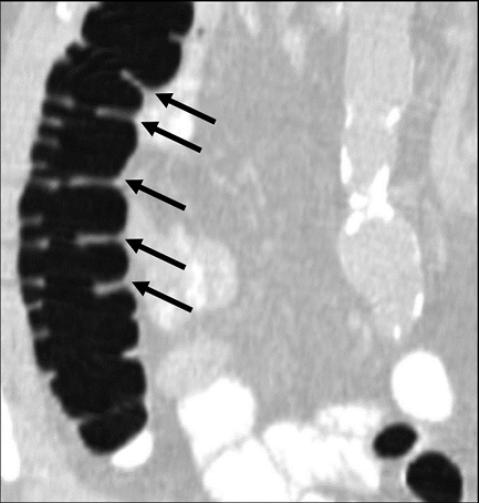 Coronal reformat demonstrating adequately distended ascending colon with at least five non-dependent haustral folds (black arrows) clearly visualized. (Multiplanar CT Colonography, Haustral Fold Selection, Axial).