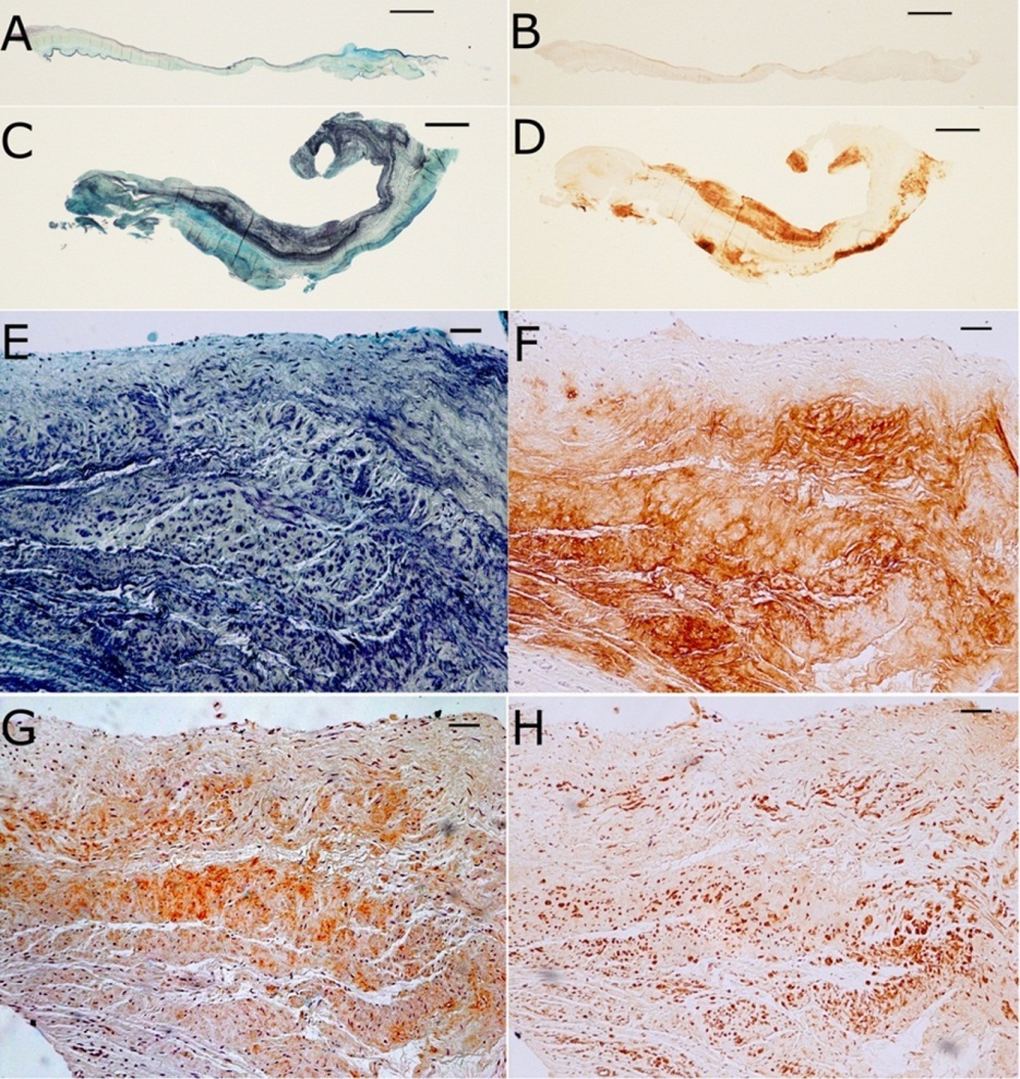 Low-magnification (scale bars = 1 mm) Movat pentachrome (A and C) and aggrecan immunohistochemistry (B and D) photomicrographs of normal (A and B) and myxomatous (C and D) mitral valves demonstrating focal aggrecan expression and co-localization of aggrecan expression with areas of myxomatous change in myxomatous mitral valves. High-magnification (scale bars = 50 μm) photomicrographs of sequential sections from a myxomatous valve demonstrating co-localization of myxomatous change with cartilage-like cells (E), aggrecan (F), type II collagen (G), and Sox9 (H).