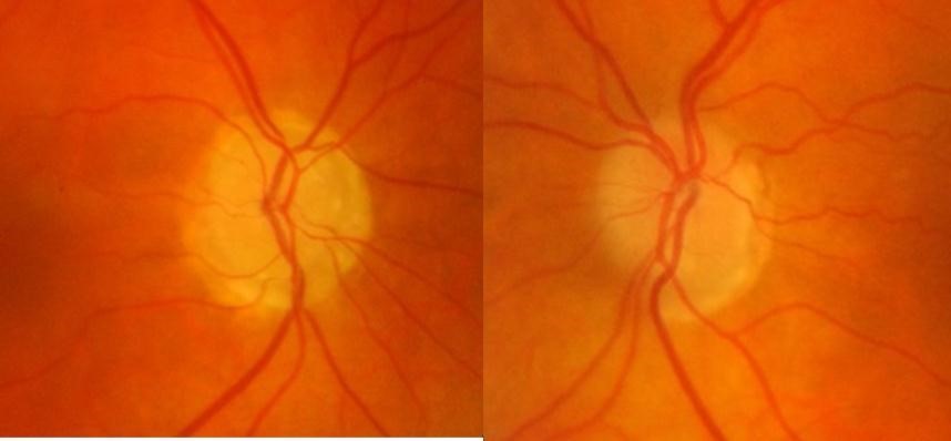 Colour fundus photos
