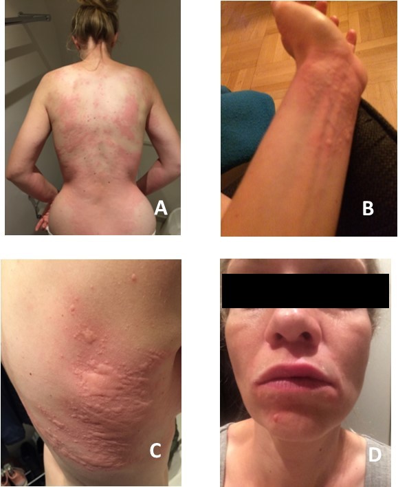 A) Urticarial rash of the back B) Urticarial rash on the wrist C) Urticarial rash and angioedema of the thorax – note the angioedematous areas where the patient has been scratching (characteristic pattern) D) Angioedema of lips and periorbital area.
