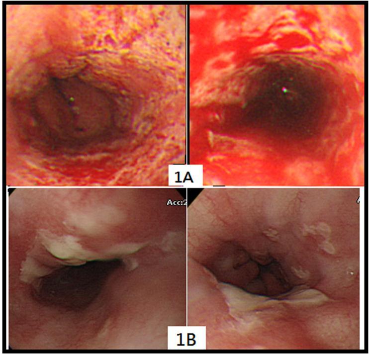 Endoscopy is showing diffuse ulcers of whole esophagus (1A) and pseudomembranous lesions with irregular yellowish patch along upper and lower esophagus (1B).