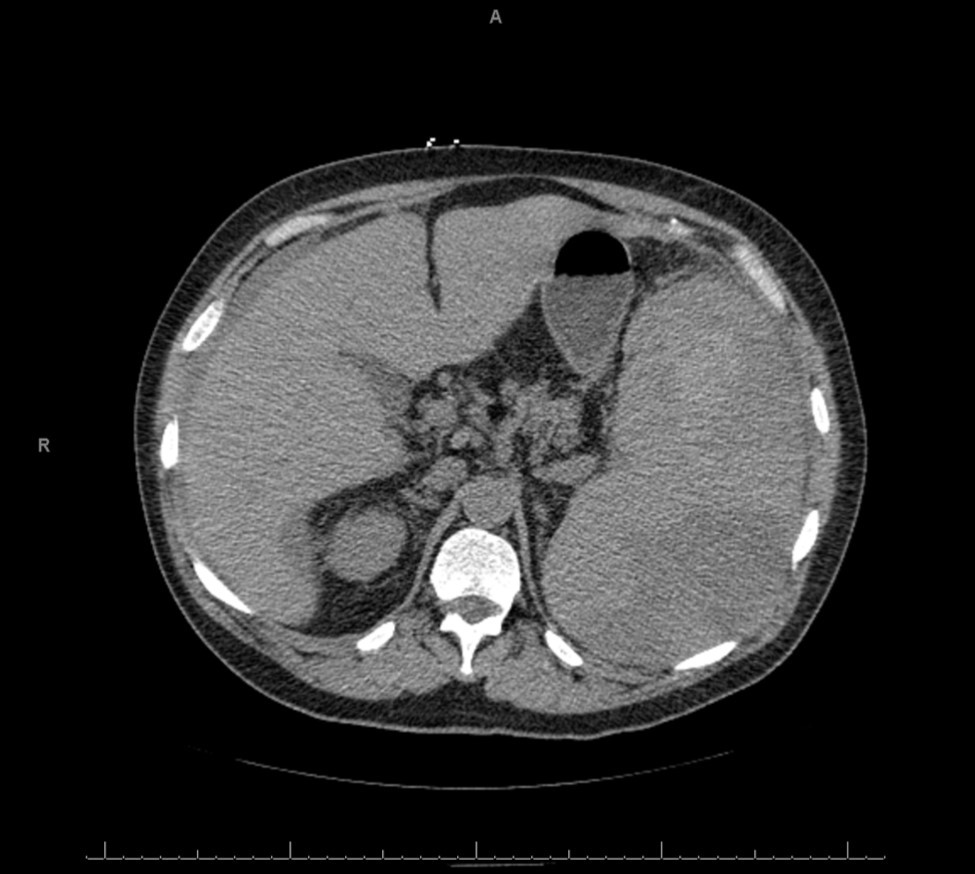 CT image of the abdomen showing the enlarged spleen. The arrows point to areas of higher attenuation suspicious for hematoma
