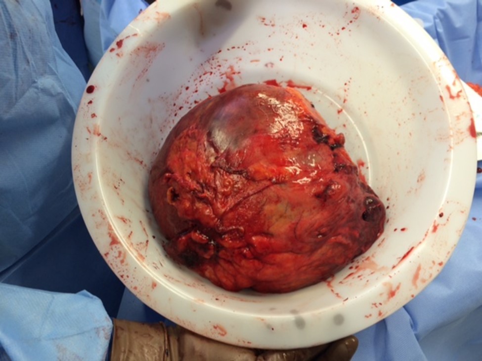 Spleen following removal – medial and hilar aspect shown. Arrow points to area of rupture.