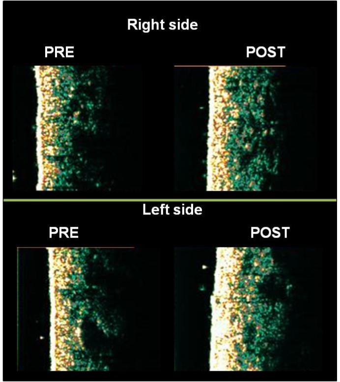 High frequency US images of one participant, showing an increase in dermal echogenicity in gluteal regions by the comparison between baseline and end of intervention