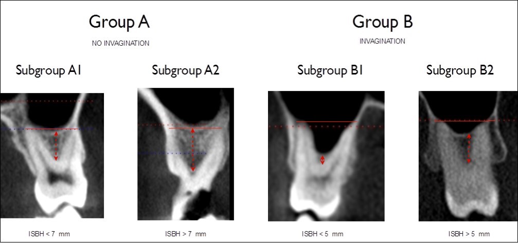 Classification in four different categories for molars, based on sinus invagination and interradicular bone septum height (ISBH).