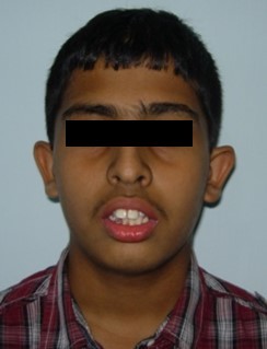 Pre-treatment extra-oral-Frontal