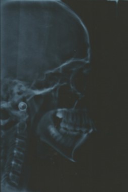 Pre-treatment lateral cephalometric radiograph