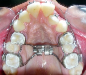 Rapid palatal expansion appliance in situ