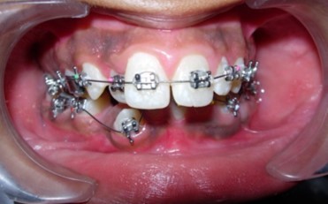 Initial levelling and alignment – Upper / Lower 0.014-inch nickel titanium wires – Frontal