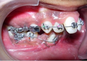 Initial levelling and alignment – Upper / Lower 0.014-inch nickel titanium wires – Right