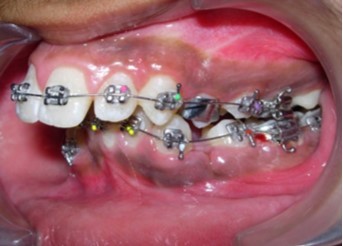 Initial levelling and alignment – Upper / Lower 0.014-inch nickel titanium wires – Left