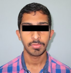 Post-treatment extra-oral-Frontal