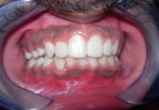 Post-treatment intra-oral-Frontal