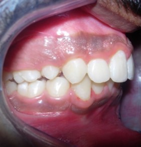 Post treatment intra-oral – Right