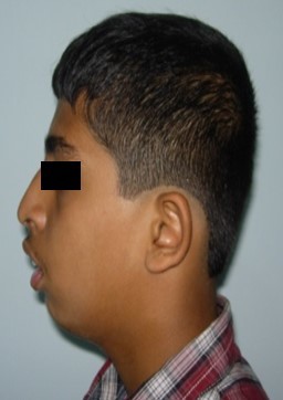 Pre-treatment extra-oral-Profile