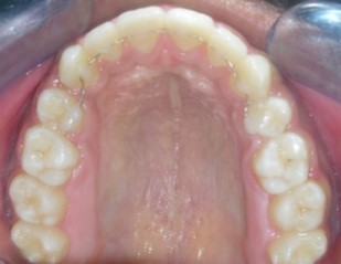Post-treatment intra-oral-Upper occlusal