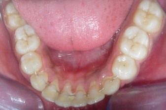 Post-treatment intra oral-Lower occlusal