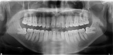 Post-treatment panoramic radiograph