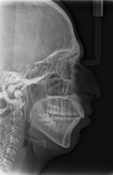 Post-treatment lateral cephalometric radiograph