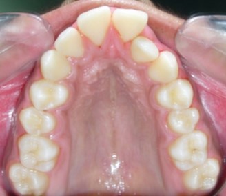 Pre aexpansion - maxillary arch