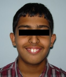 Pre-treatment extra-oral-Smiling