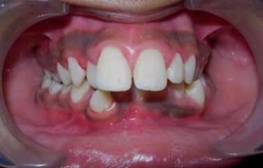 Pre-treatment intra-oral-Frontal
