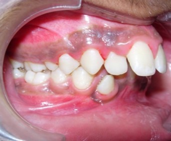 Pre-treatment intra-oral-Right