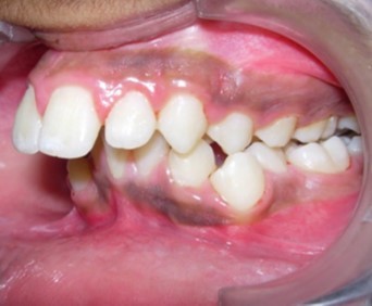 Pre-treatment intra-oral-Left
