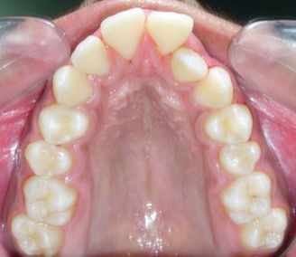 Pre-treatment intra-oral-Upper occlusal
