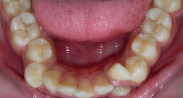 Pre-treatment intra-oral-Lower occlusal