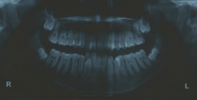Pre-treatment panoramic radiograph