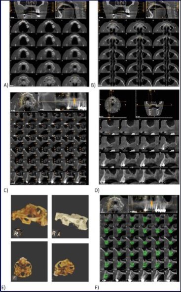 Routine sequential CBCT scans A and B) Axial sections; C) Cross section; D) Oblique sagittal section; E) 3-D reconstruction; F) Width measurement