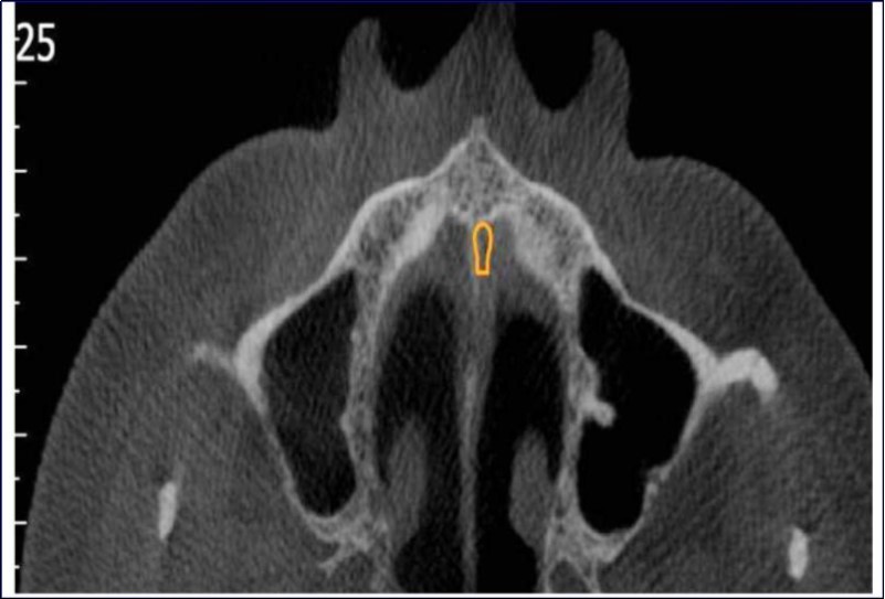 Axial section of CBCT showing sinus septae