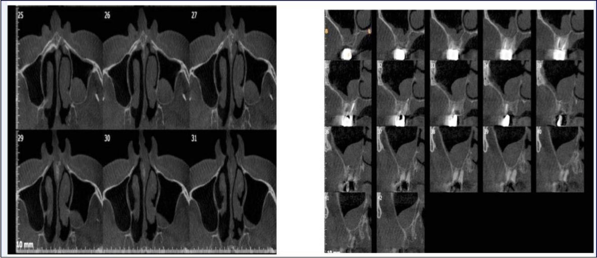 Axial sections of CBCT showing sinus mucosal thickening