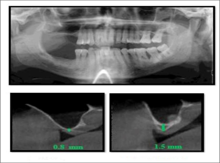 Pre-operative Orthopantomograph and cross sections of CBCT showing residual alveolar bone height