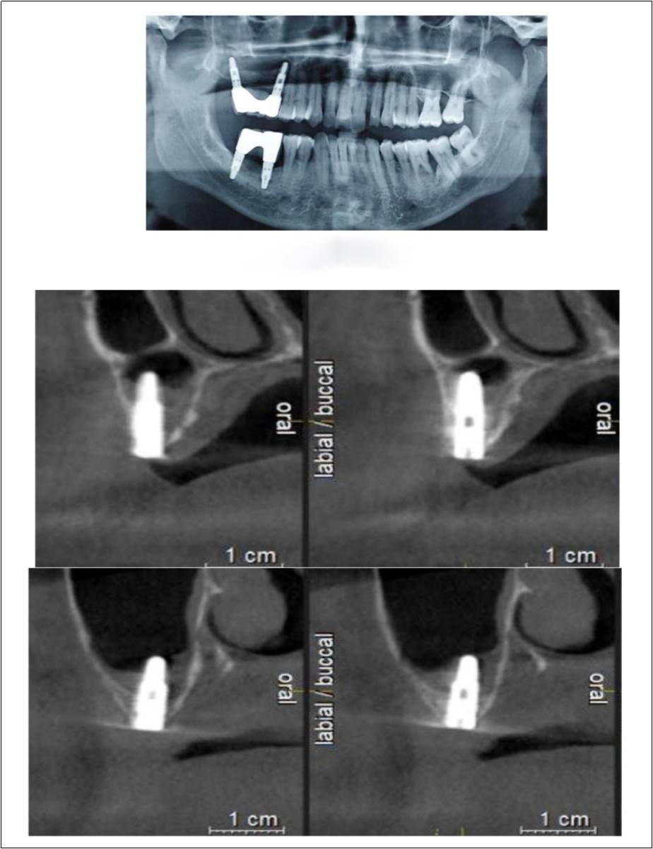 Post-operative Orthopantomograph and cross sections of CBCT showing an increase in residual alveolar bone height