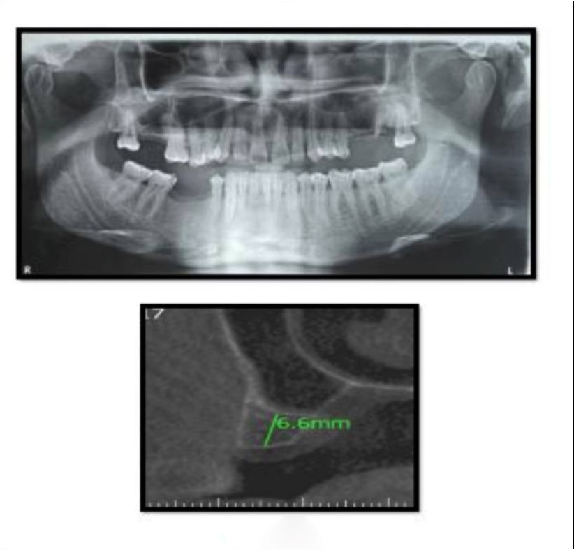 Pre-operative Orthopantomograph and cross section of CBCT showing residual alveolar bone height