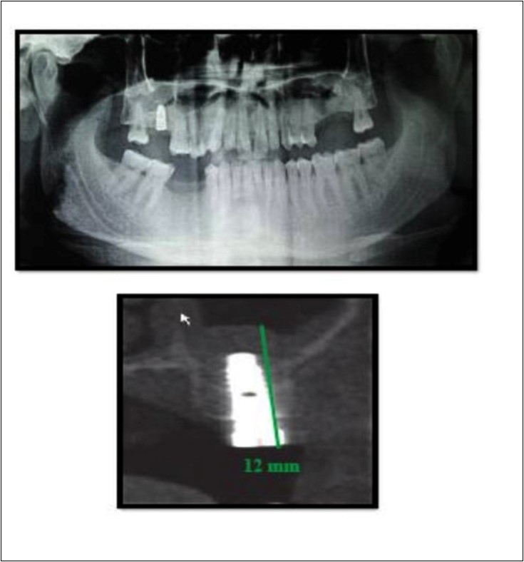 Post-operative Orthopantomograph and cross section of CBCT showing residual alveolar bone height