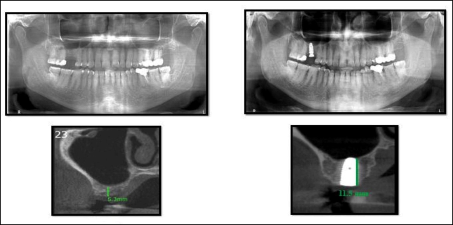 Pre-operative and post-operative Orthopantomographs and cross sections of CBCT showing residual alveolar bone height