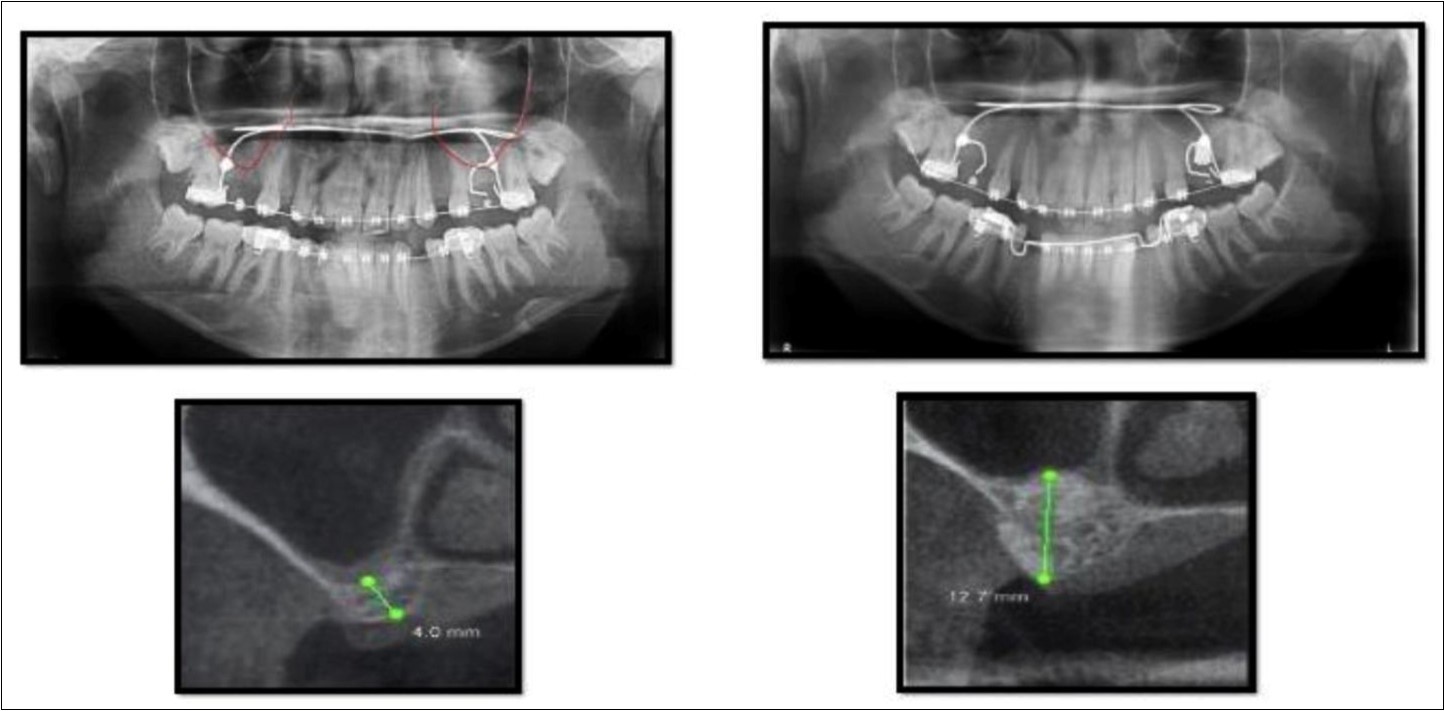 Pre-operative and post-operative Orthopantomographs and cross sections of CBCT showing residual alveolar bone height