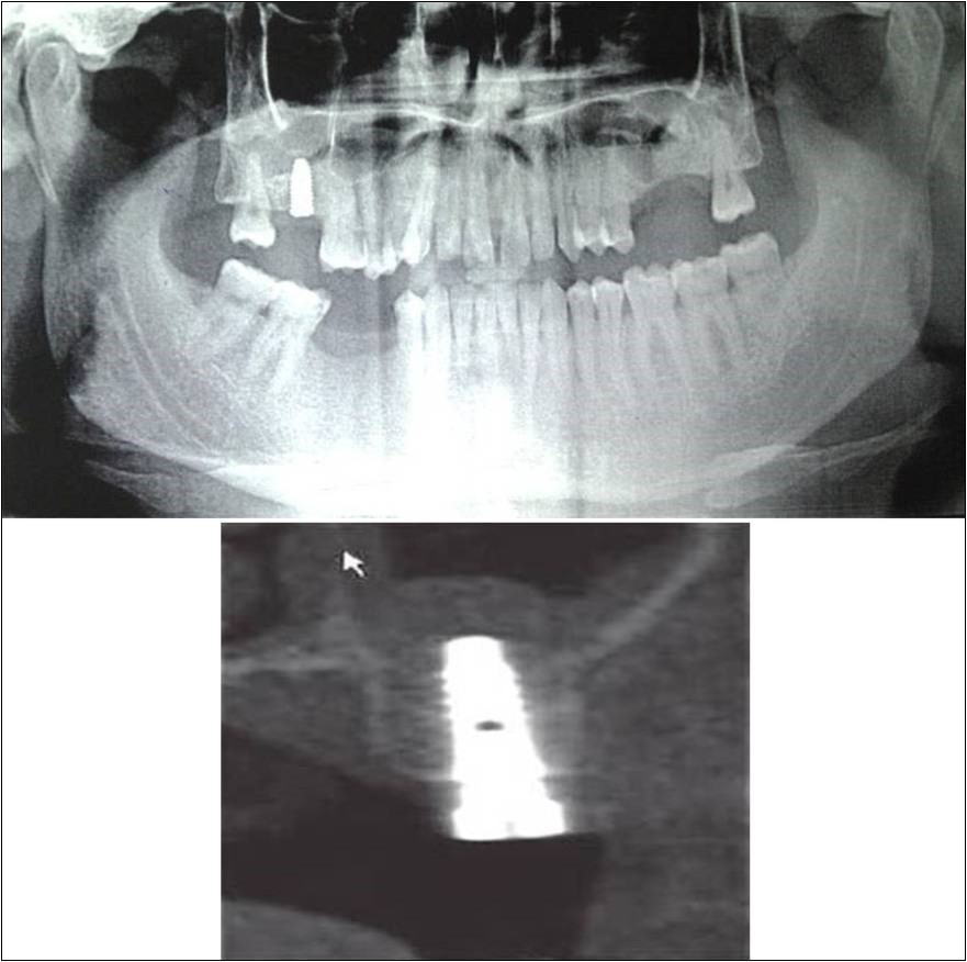 (a,b) Post-treatment OPG and cross section of CBCT showing residual alveolar bone height for Case No.2
