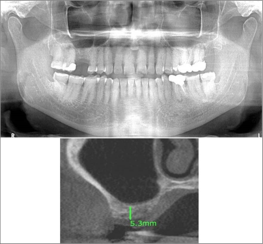 (a,b) Pre-treatment OPG and cross section of CBCT showing residual alveolar bone height for Case No.3