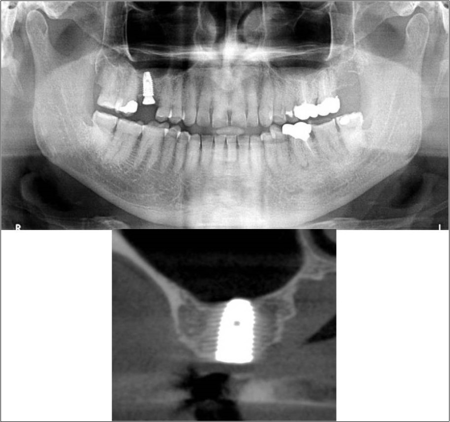 (a,b) Post-treatment OPG and cross section of CBCT showing residual alveolar bone height for Case No.3;