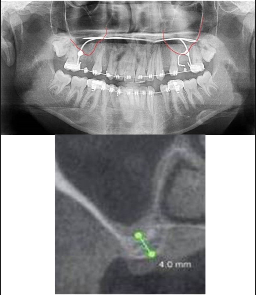 (a,b) Pre-treatment OPG and cross section of CBCT showing residual alveolar bone height for Case No.4;