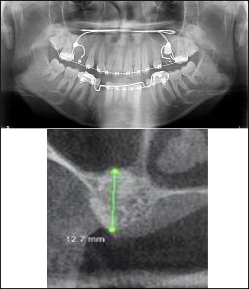 (a,b) Post-treatment OPG and cross section of CBCT showing residual alveolar bone height for Case No.4;