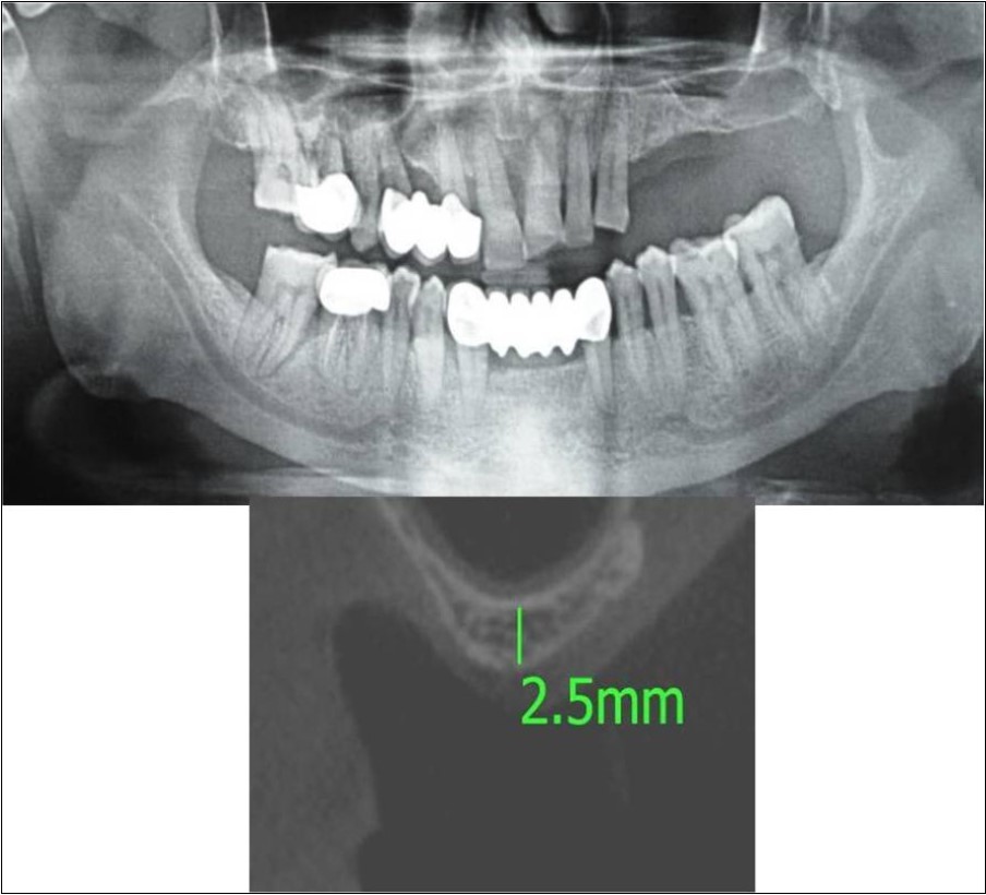 a,b. Pre-treatment OPG and cross section of CBCT showing residual alveolar bone height for Case No.5;