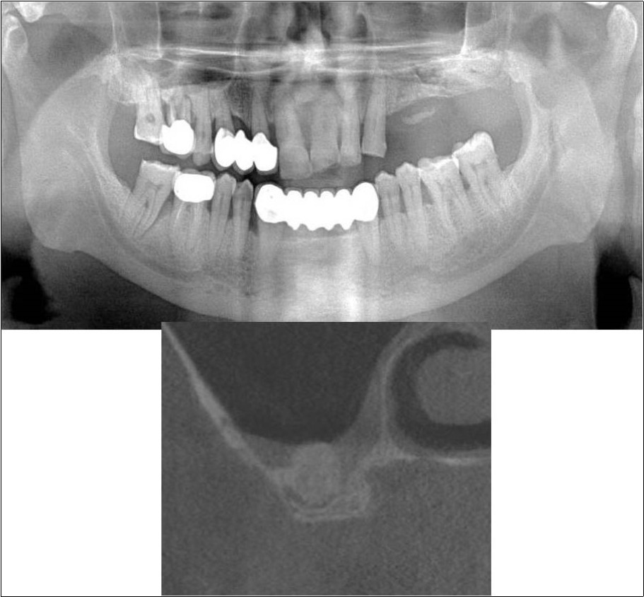 a,b. Post-treatment OPG and cross section of CBCT showing residual alveolar bone height for Case No.5;