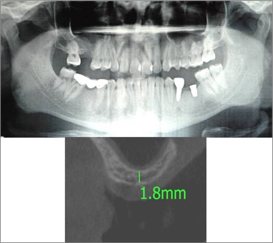 a,b. Pre-treatment OPG and cross section of CBCT showing residual alveolar bone height for Case No.6;