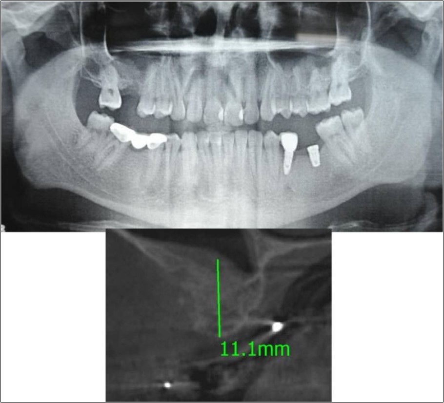 (a,b) Post-treatment OPG and cross section of CBCT showing residual alveolar bone height for Case No.6;